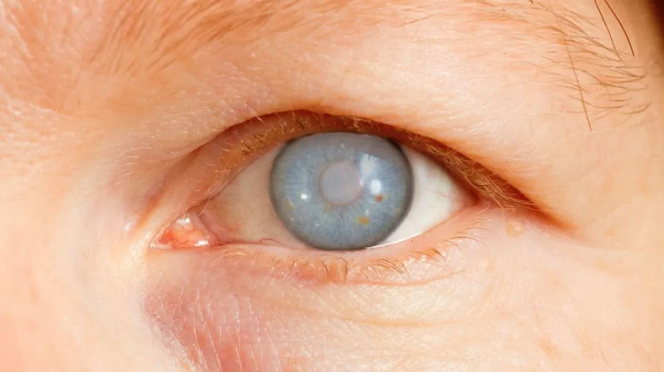 Cirugía de Glaucoma
