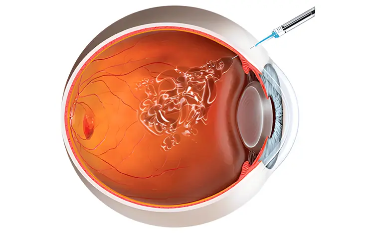Tratamiento por retinopatía