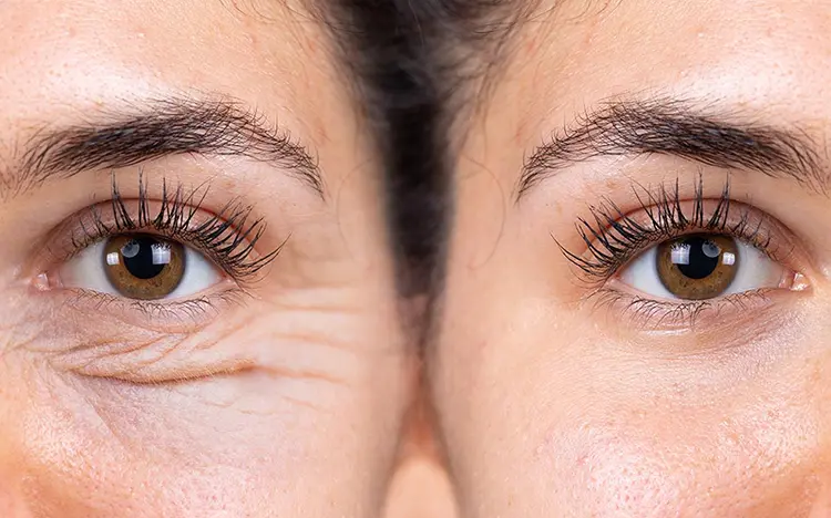 Oculoplastia