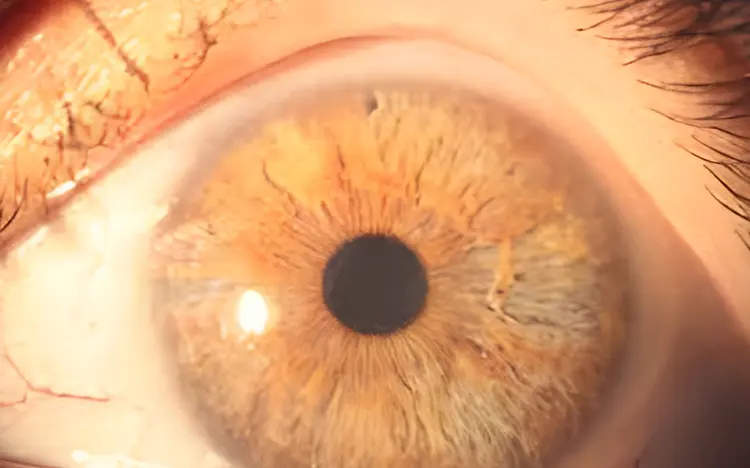 Glaucoma